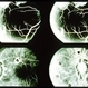 Massive Vitreous Hemorrhage 1